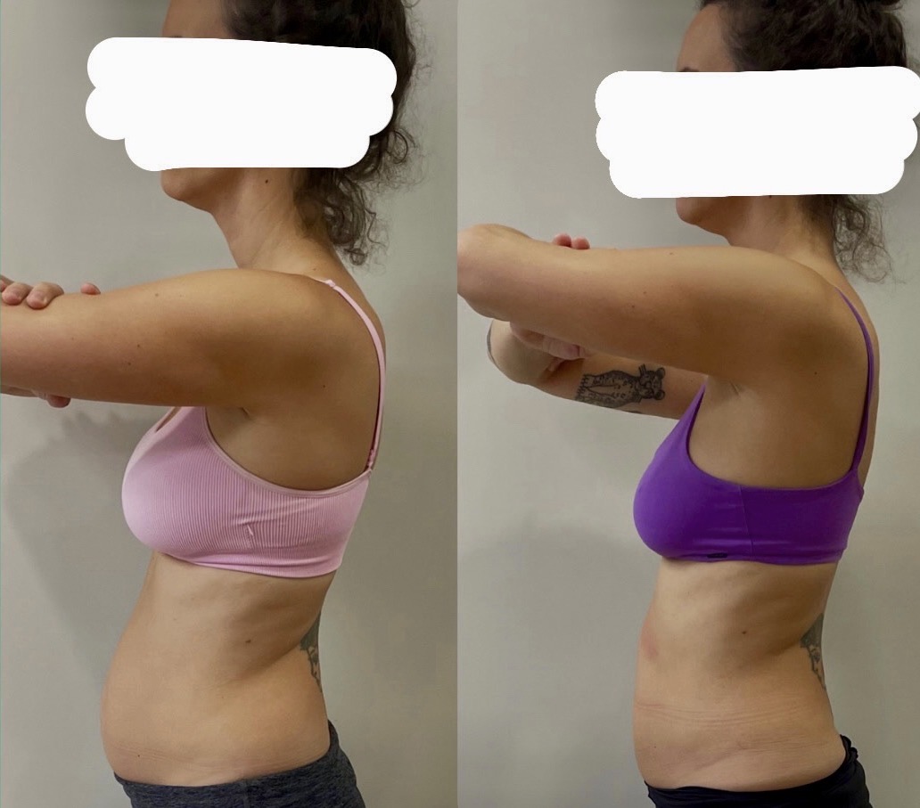 Resultado antes e depois do protocolo ZIPER
