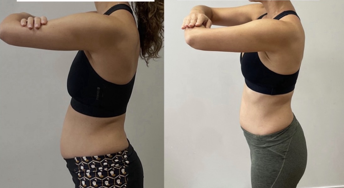 Resultado antes e depois do protocolo ZIPER