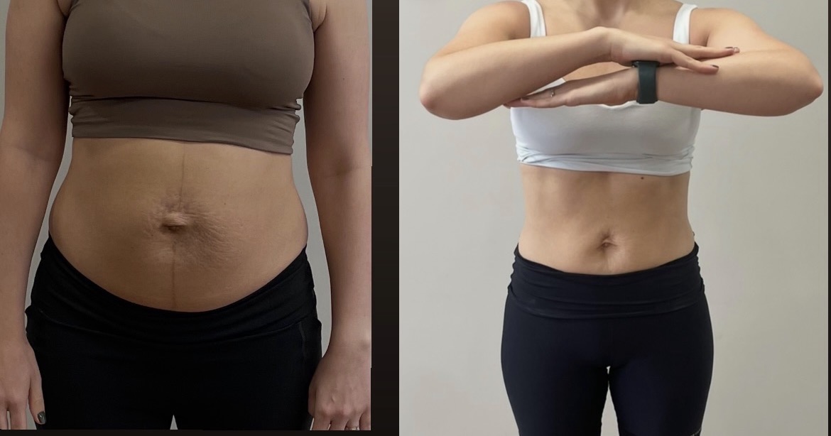 Resultado antes e depois do protocolo ZIPER